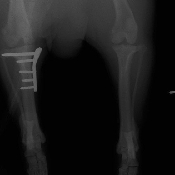 術後1ヶ月正面像