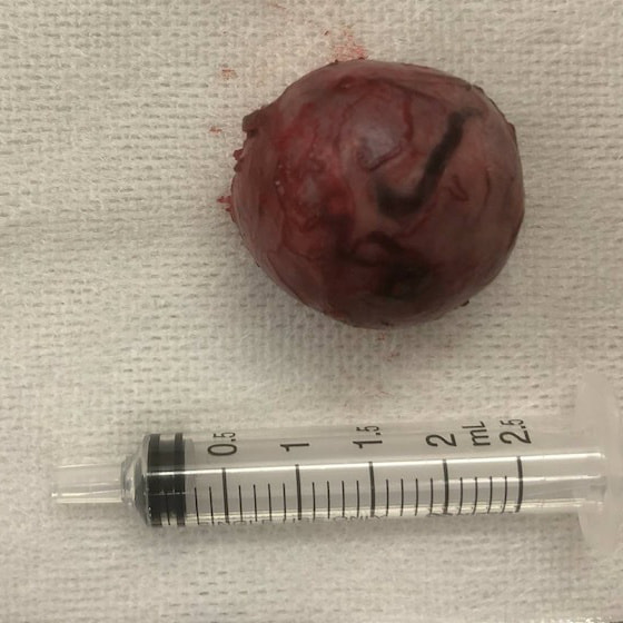 摘出した腫瘍