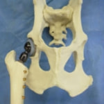 THR Bone Model